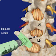 Lumbar epidural steroid injection procedure code