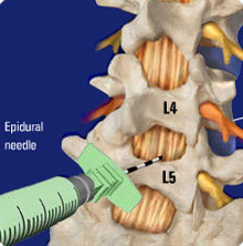 Epidural Injection