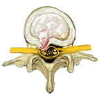 Herniated Disc