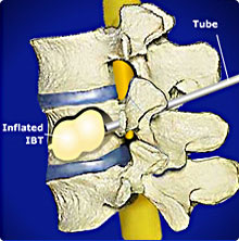 Kyphoplasty