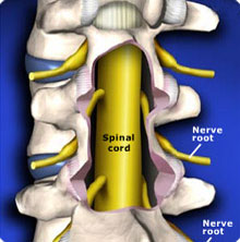 Laminectomy