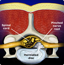 Microendoscopic Discectomy