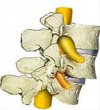 Spondylolisthesis